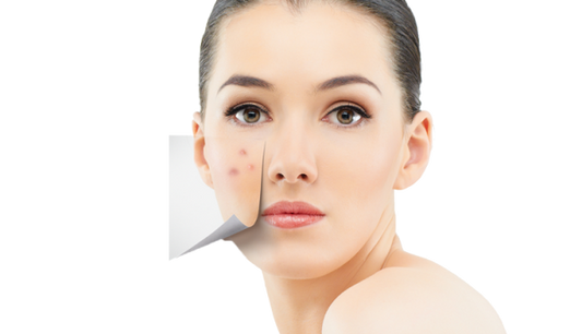 Riebi oda ir aknė - kaip kovoti?